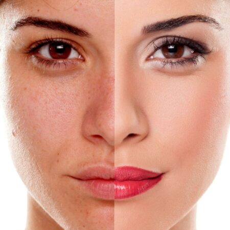 Tratamiento Despigmentante Tratamiento Despigmentante - Kaya Kalpa - Centro de Spa y Belleza en Rosario